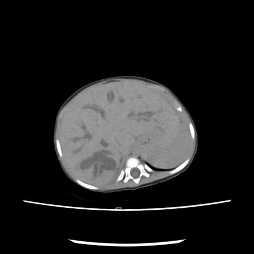 Caroli disease with autosomal recessive polycystic kidney disease (ARPKD) (Radiopaedia 89651-106703 E 44).jpg