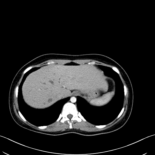 Caroli disease with medullary sponge kidney (Radiopaedia 82622-96804 C 15).jpg
