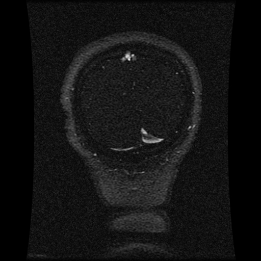 Carotid arterial dissection with acute cerebral infarction (Radiopaedia 26636-26784 MRV 43).jpg