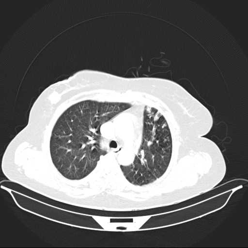 File:Carotid body tumor (Radiopaedia 21021-20948 Axial lung window 11).jpg
