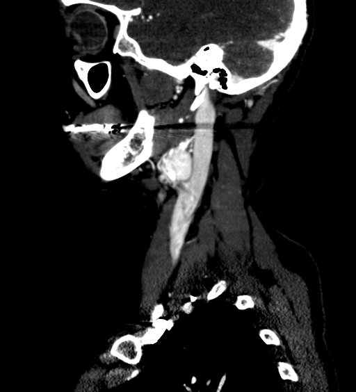 File:Carotid body tumor (Radiopaedia 39845-42300 D 9).jpg