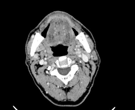 File:Carotid body tumor (Radiopaedia 61750-69757 Axial Post contrast 32).jpg
