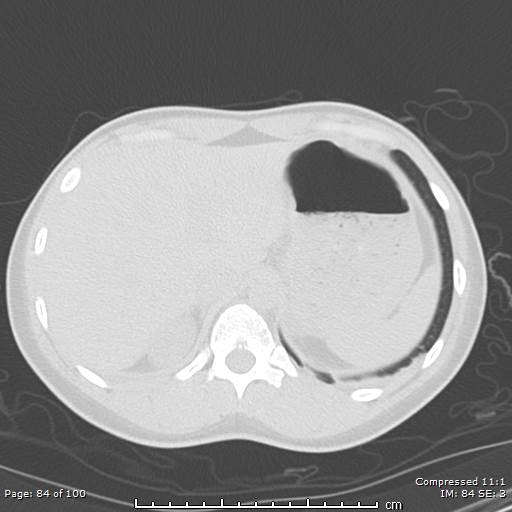 Catamenial pneumothorax (Radiopaedia 54382-60600 Axial non-contrast 84).jpg