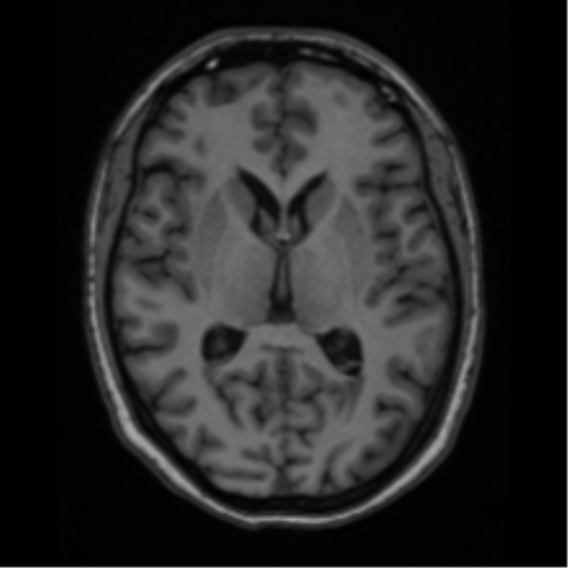 File:Cavernoma with bleed - midbrain (Radiopaedia 54546-60774 Axial T1 23).png