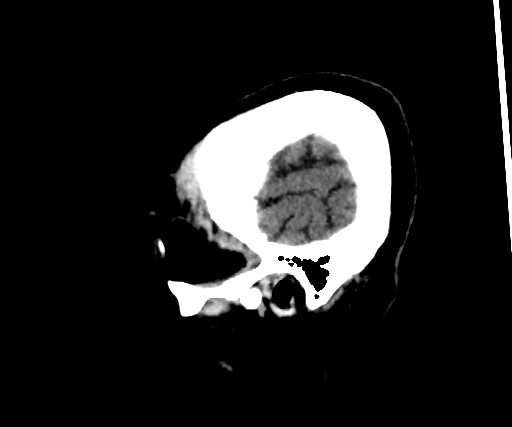Cavernous hemangioma of the cerebellar falx (Radiopaedia 73025-83723 B 296).jpg