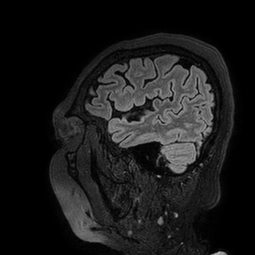 Cavernous hemangioma of the cerebellar falx (Radiopaedia 73025-83724 Sagittal FLAIR 184).jpg