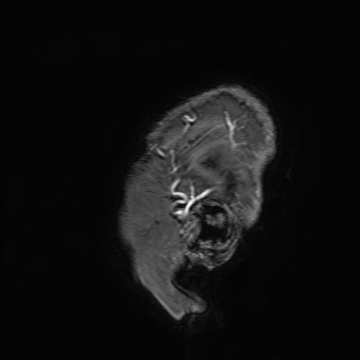File:Cavernous hemangioma of the cerebellar falx (Radiopaedia 73025-83724 Sagittal T1 C+ 2).jpg