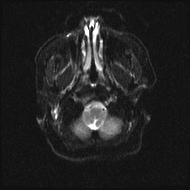 Cavernous sinus meningioma (Radiopaedia 63682-72367 DWI 3).jpg