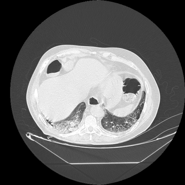 Cavitating bronchogenic carcinoma (Radiopaedia 44489-48162 Axial lung window 70).jpg