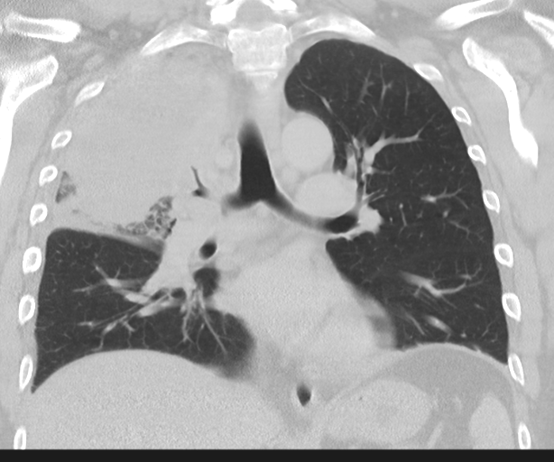 Cavitating pneumonia (Radiopaedia 45998-50329 Coronal lung window 28).png