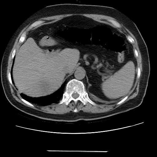 Cavitating pulmonary metastases (Radiopaedia 89545-106544 Axial non-contrast 53).jpg