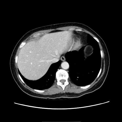 Cecal adenocarcinoma (Radiopaedia 75909-87331 A 18).jpg