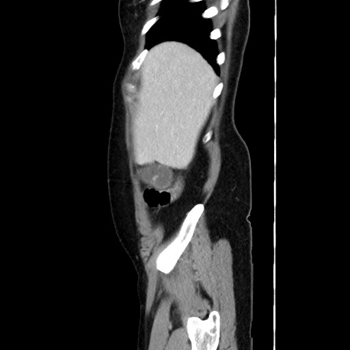 Cecal adenocarcinoma (Radiopaedia 75909-87331 C 15).jpg