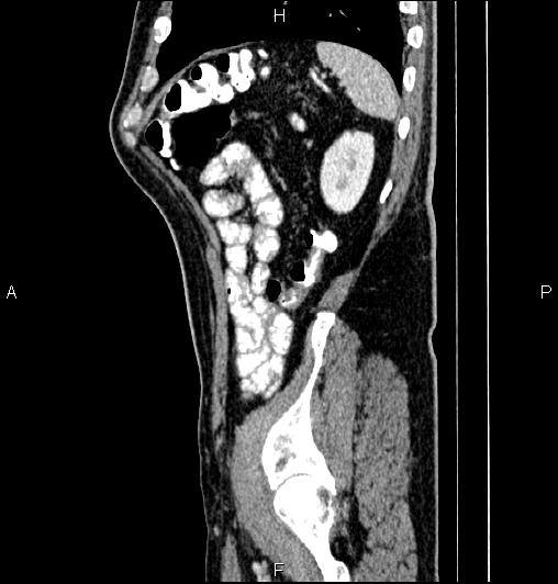 Cecal adenocarcinoma (Radiopaedia 85324-100916 E 77).jpg