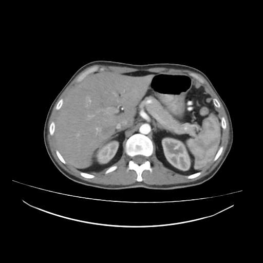 Cecal carcinoma with local lymphadenopathy (Radiopaedia 31428-32240 A 11).jpg
