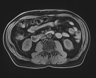 Cecal mass causing appendicitis (Radiopaedia 59207-66532 Axial T1 70).jpg
