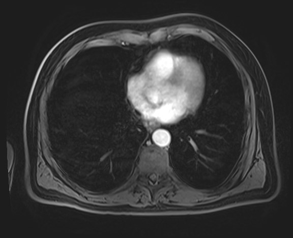 File:Cecal mass causing appendicitis (Radiopaedia 59207-66532 H 13).jpg