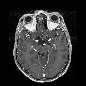 Central-variant posterior reversible encephalopathy syndrome (PRES) (Radiopaedia 43880-47358 Axial T1 C+ 62).jpg