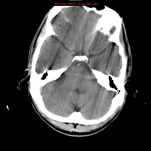 File:Central nervous system vasculitis (Radiopaedia 8410-9234 Axial non-contrast 7).jpg