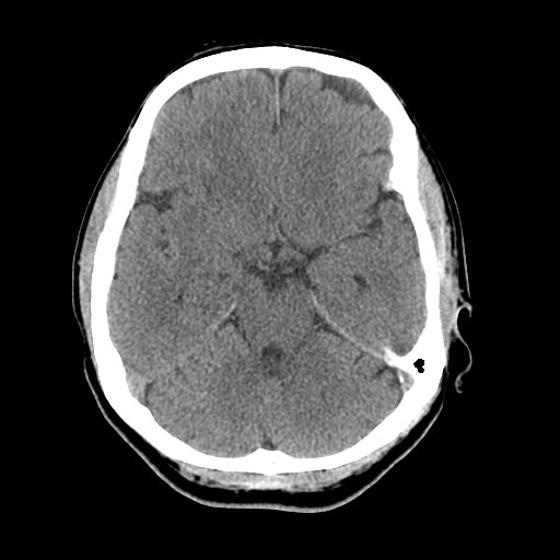 Central neurocytoma (Radiopaedia 68725-78432 Axial non-contrast 17).jpg