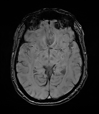 File:Central neurocytoma (Radiopaedia 71068-81303 Axial SWI 28).jpg