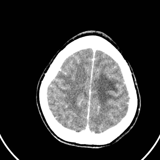 Central neurocytoma (Radiopaedia 84497-99871 B 41).jpg