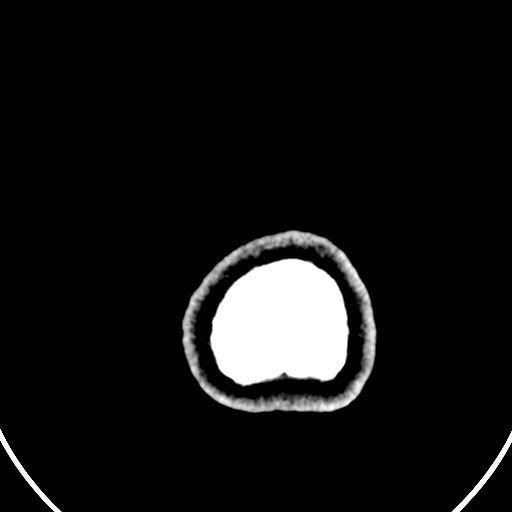 Central neurocytoma (Radiopaedia 84497-99871 B 53).jpg