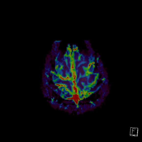 Central neurocytoma (Radiopaedia 84497-99872 Axial Perfusion 25).jpg