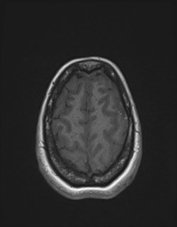 File:Central neurocytoma (Radiopaedia 84497-99872 Axial T1 163).jpg