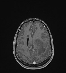Central neurocytoma (Radiopaedia 84497-99872 Axial T1 C+ 113).jpg