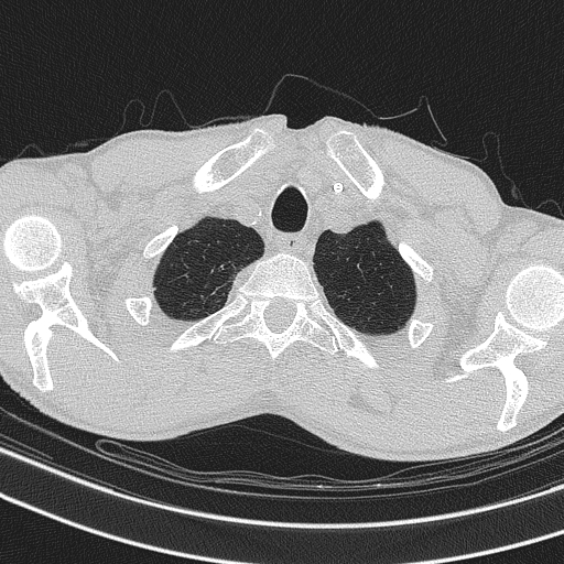 Central venous catheter tip extravasation (Radiopaedia 82828-97113 Axial lung window 13).jpg