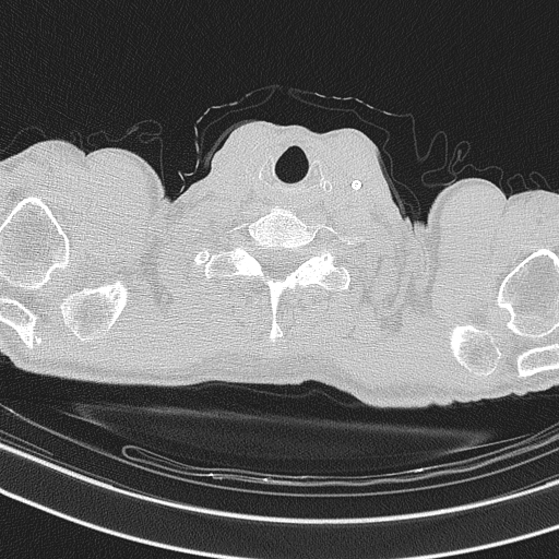 Central venous catheter tip extravasation (Radiopaedia 82828-97113 Axial lung window 4).jpg