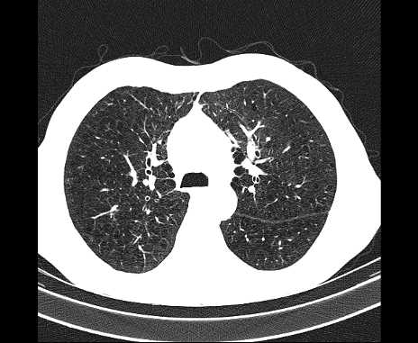 Centrilobular pulmonary emphysema (Radiopaedia 62468-70718 Axial lung window 27).jpg