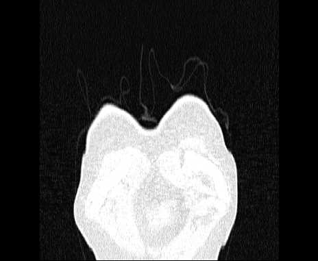 Centrilobular pulmonary emphysema (Radiopaedia 62468-70718 Coronal lung window 2).jpg