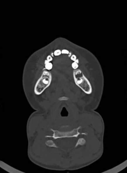 Cerebellar abscess (Radiopaedia 73727-84527 Axial bone window 2).jpg