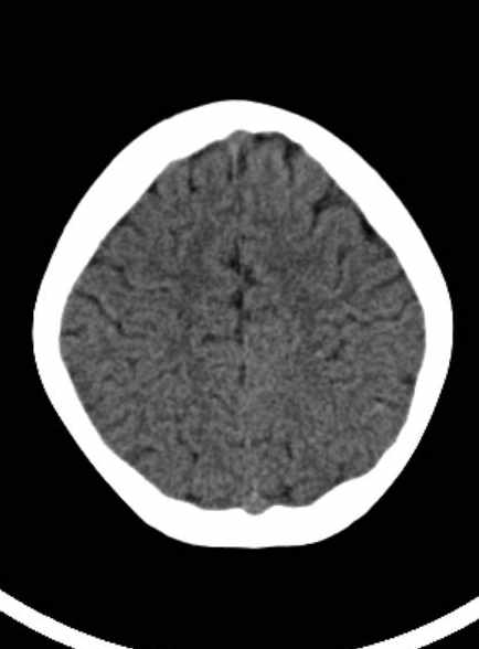Cerebellar abscess (Radiopaedia 73727-84527 Axial non-contrast 53).jpg
