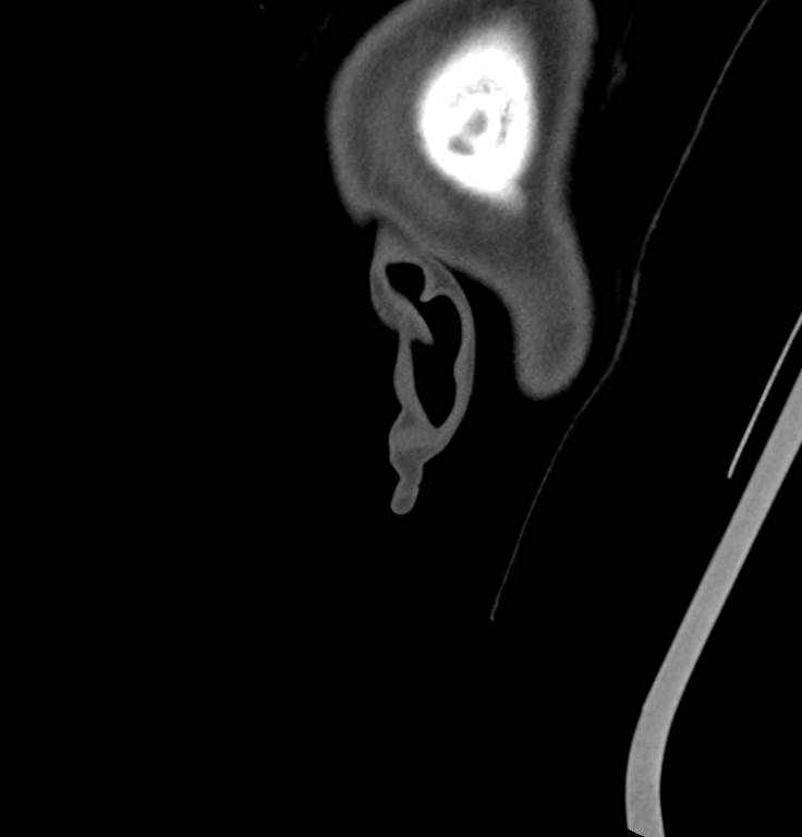 Cerebellar abscess (Radiopaedia 73727-84527 Sagittal bone window 52).jpg