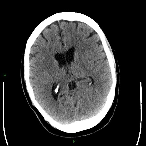 Cerebellar abscess (Radiopaedia 78135-90671 Axial non-contrast 60).jpg