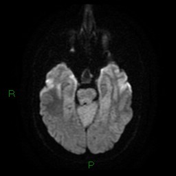 Cerebellar abscess (Radiopaedia 78135-90678 Axial DWI 12).jpg