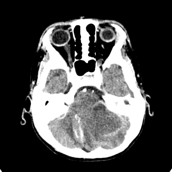 Cerebellar abscess secondary to mastoiditis (Radiopaedia 26284-26412 Axial C+ delayed 37).jpg
