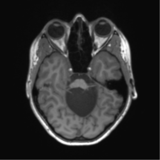 Cerebellar agenesis with hypoplastic pons (pontocerebellar hypoplasia) (Radiopaedia 57224-64138 Axial T1 26).png