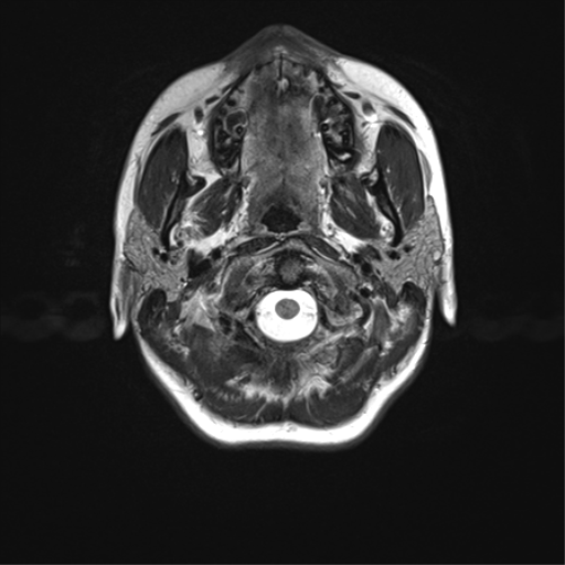 File:Cerebellar agenesis with hypoplastic pons (pontocerebellar hypoplasia) (Radiopaedia 57224-64138 Axial T2 3).png