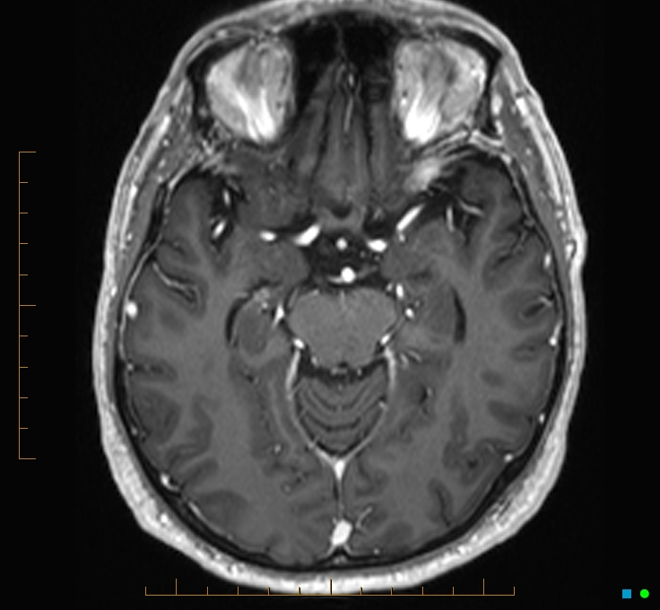 Cerebellar gangliocytoma (Radiopaedia 65377-74422 Axial T1 C+ 49).jpg