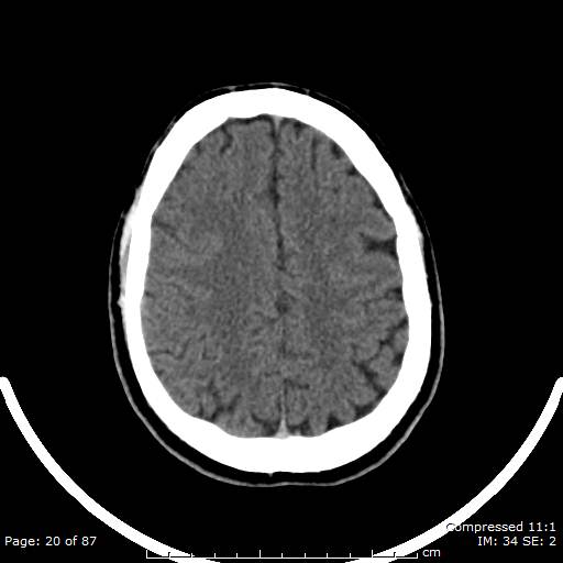 Cerebellar hemangioblastoma (Radiopaedia 52360-58258 Axial non-contrast 20).jpg