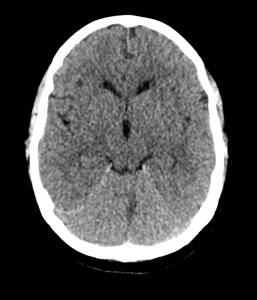 Cerebellar metastases - colorectal adenocarcinoma (Radiopaedia 40947-43652 Axial non-contrast 26).png
