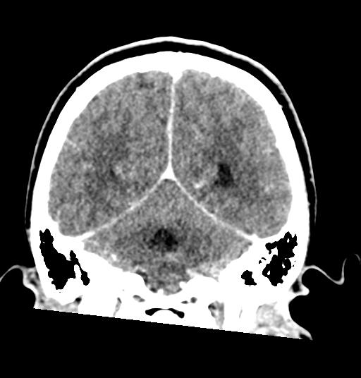 Cerebellar metastases - colorectal adenocarcinoma (Radiopaedia 40947-43652 Coronal C+ 65).png
