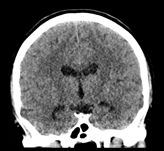 Cerebellar metastases - colorectal adenocarcinoma (Radiopaedia 40947-43652 Coronal non-contrast 50).png