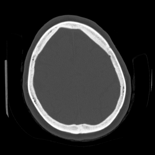 Cerebellar metastasis (cystic appearance) (Radiopaedia 41395-44258 Axial bone window 54).png