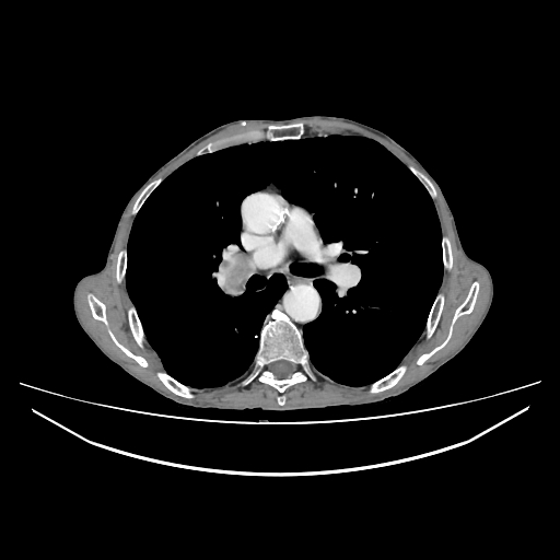 Cerebellar metastasis - lung tumor (Radiopaedia 69317-79150 A 16).jpg