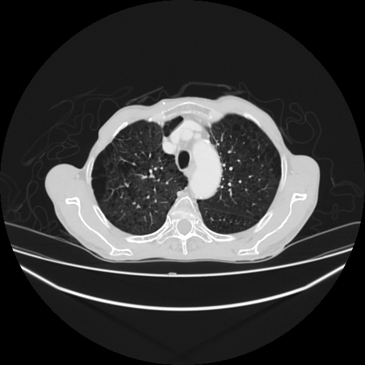 File:Cerebellar metastasis - lung tumor (Radiopaedia 69317-79150 Axial lung window 8).jpg